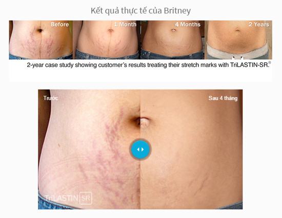 Kem trị rạn da sau sinh Trilastin USA 
