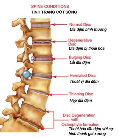 Bài tập yoga chữa thoái hóa cột sống hiệu quả